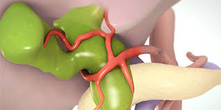 Choledochal Cyst Treatment in Electronic City